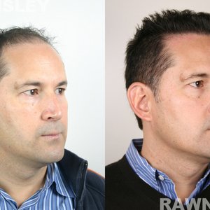 Rawnsley Hair Restoration on Yelp