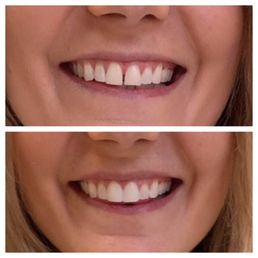 Cosmetic Bonding by Dr. Dow