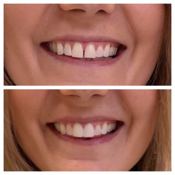 Chicago Style Smiles - Cosmetic Bonding by Dr. Dow - General Dentistry Near Me - Chicago, Illinois