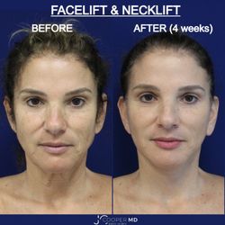 Jason Cooper Plastic Surgery - Deep Plane Facelift and Platysmaplasty Necklift by Dr. Jason Cooper, Board Certified Plastic Surgeon located in Jupiter and Palm Beach, FL