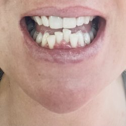 Crescent Prosthodontics - After