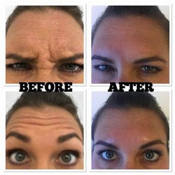 Rejuvenation & Rehydration with Nurse Azure - Forehead lines and brow lift to open the eyes