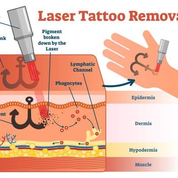 Broken-ink Laser Tattoo Removal - Basic rendering of how laser tattoo removal works within your body. - Tattoo Removal Near Me - Philadelphia, Pennsylvania Broken-ink Laser Tattoo Removal - Basic rendering of how laser tattoo removal works within your body. - Tattoo Removal Near Me - Philadelphia, Pennsylvania