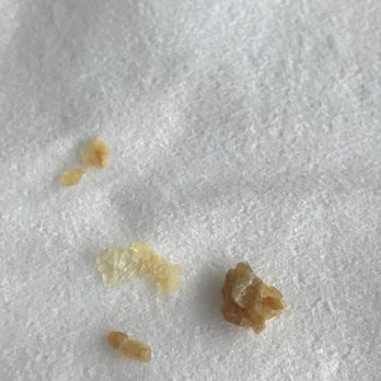 Nilesh Patel - This is not a pleasant sight but it has to be uploaded as a proof. Date and time stamped today. - Ear Nose & Throat Near Me - Queens, New York