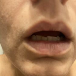 Monica Scheel, MD of Dermatology - Scar tissue upper lip