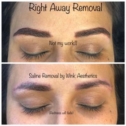 Wink Aesthetics & Spa  - Right away removal