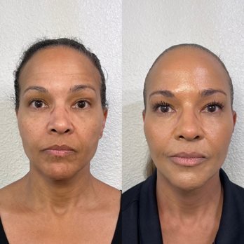 Organic Skin Studio - Before & healed (2 week follow up) - Skin Care Near Me - Sacramento, California Organic Skin Studio - Before & healed (2 week follow up) - Skin Care Near Me - Sacramento, California