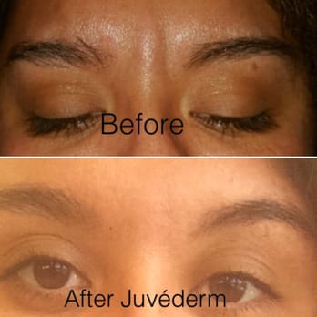 My Look - Juvéderm and Botox. I was not frowning in that top picture that's actually how deep my wrinkles were. - Cosmetic Surgeons Near Me - Pasadena, California My Look - Juvéderm and Botox. I was not frowning in that top picture that's actually how deep my wrinkles were. - Cosmetic Surgeons Near Me - Pasadena, California