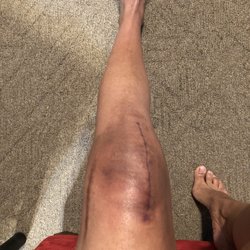Jonah B. Hulst, MD - Look at how neat and clean that slice is!!