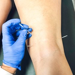Dynamic Physical Therapy & Wellness - Interested in dry needling?! Contact us to learn more and schedule your appointment!