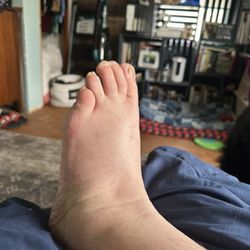Memorial Hospital of Lafayette County - And this is what my foot looks like