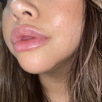 The Aesthetics Lab - 1 week, swelling almost all gone - Medical Spas Near Me - Las Vegas, Nevada The Aesthetics Lab - 1 week, swelling almost all gone - Medical Spas Near Me - Las Vegas, Nevada