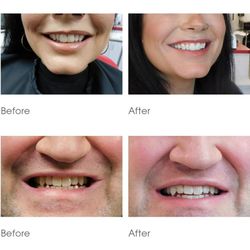 The Whitening Bar STL