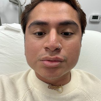 LaserAway - During my first week - Tattoo Removal Near Me - New York, New York LaserAway - During my first week - Tattoo Removal Near Me - New York, New York