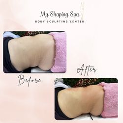 My Shaping Spa - 4cm down with our Cryolipolysis treatment.