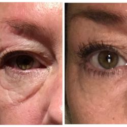 Beautiful Laser Center - Plasma Pen No-Surgery Eyelift 409-454-9502