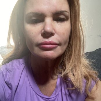 ReNu Wellness Clinic - Filler for lips and cheek fillers for my smile lines - IV Hydration Near Me - Scottsdale, Arizona ReNu Wellness Clinic - Filler for lips and cheek fillers for my smile lines - IV Hydration Near Me - Scottsdale, Arizona