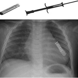 Loma Linda International Heart Institute - Implant placed subcutaneously
