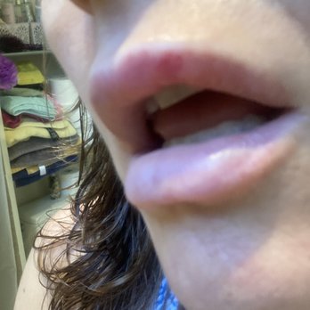 Renee Patel, MD - Next day of my second injection.  (Photo without makeup.) - Laser Hair Removal Near Me - Downey, California