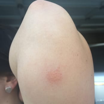 Candy Cane Inn - Bed Bug Bites - Hotels Near Me - Anaheim, California
