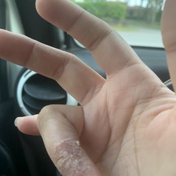 Beal Nail Spa Lounge - What my hands look like from working none stop there. My finger literally looks purple - Waxing Near Me - Fort Walton Beach, Florida Beal Nail Spa Lounge - What my hands look like from working none stop there. My finger literally looks purple - Waxing Near Me - Fort Walton Beach, Florida