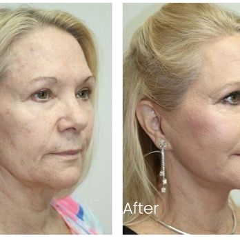 ARC Plastic Surgery - Facelift and necklift to tighten & sculpt the jawline with fat grafting to highlight the cheek bones - Cosmetic Surgeons Near Me - Miami, Florida ARC Plastic Surgery - Facelift and necklift to tighten & sculpt the jawline with fat grafting to highlight the cheek bones - Cosmetic Surgeons Near Me - Miami, Florida