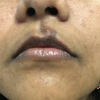 Kashish Salon - Upper lip skin rip off by the owner lady during threading. - Hair Removal Near Me - Milpitas, California Kashish Salon - Upper lip skin rip off by the owner lady during threading. - Hair Removal Near Me - Milpitas, California