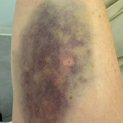 Providence Holy Family Hospital - This is how nurses FORCE IV even when not in the vein. This is day 3. First 2 excruciating pain.