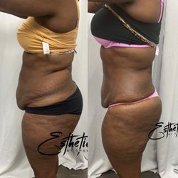 Esthetics By Shawna - Body contouring