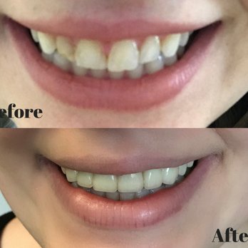 Amer Safadi DMD - An amazing "after" to a not-so-pretty "before". I love my natural, gorgeous new smile. Thank you so much, Dr. Safadi! - General Dentistry Near Me - San Jose, California