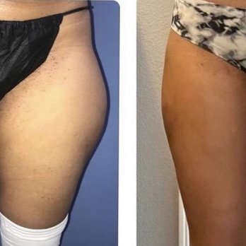 Thomas W. Barnes, MD - Liposuction Outer Thighs - Cosmetic Surgeons Near Me - Newport Beach, California