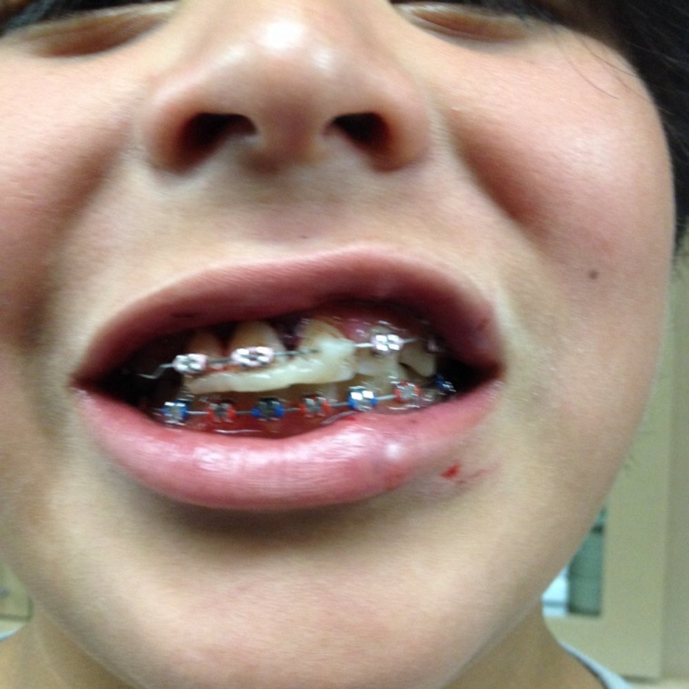 Premier Orthodontics - End result. - Orthodontists Near Me - Oxnard, California Premier Orthodontics - End result. - Orthodontists Near Me - Oxnard, California