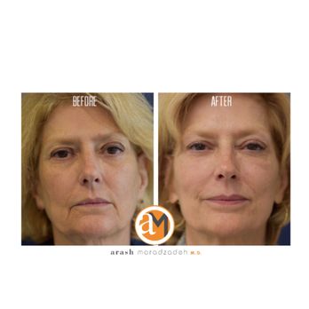 Arash Moradzadeh, MD - Liquid Lift! Our patient is 18 months older in her after photo and looks 10 years younger! - Ear Nose & Throat Near Me - Beverly Hills, California