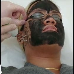 During carbon laser facial