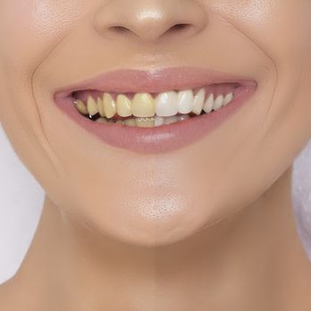 Gem Spa - Laser Hair Removal Near Me - Sandy, Utah Gem Spa - Laser Hair Removal Near Me - Sandy, Utah