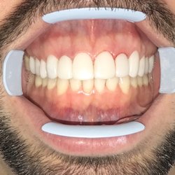 Durham Dentistry - AFTER Invisalign and cosmetic modifications