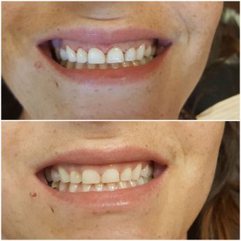 Gurrinder S Atwal DDS - Before and after gum lasering to make the smile bigger.. Feeling so much more confident now and it didn't hurt at all!! - General Dentistry Near Me - Tracy, California Gurrinder S Atwal DDS - Before and after gum lasering to make the smile bigger.. Feeling so much more confident now and it didn't hurt at all!! - General Dentistry Near Me - Tracy, California