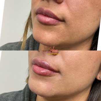 Jolene Aesthetics - Already gorgeous lips but perfection for this first time lip filler patient. - Medical Spas Near Me - Carlsbad, California Jolene Aesthetics - Already gorgeous lips but perfection for this first time lip filler patient. - Medical Spas Near Me - Carlsbad, California