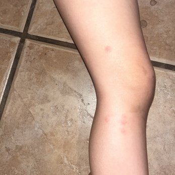 Great Wolf Lodge - Bites on legs - Water Parks Near Me - Scottsdale, Arizona Great Wolf Lodge - Bites on legs - Water Parks Near Me - Scottsdale, Arizona