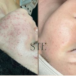 Skin Therapy by Erica K. - Before and after of my client who went through my Integrative Acne Program