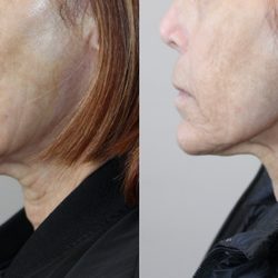 Michael Sarti, MD - Combine the Instalift and The Secret Radiofrequency Microneedling for spectacular results.