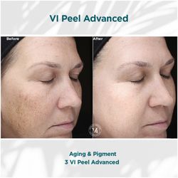 Advanced Laser Clinic of Tacoma - VI Peels are medium-depth peels. Safe for all skin types and tones. Painless. Proven to accelerate the results of other treatments.