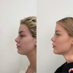 Beauty Boost Med Spa - Jawline & Cheek Filler