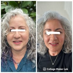 Walnut Creek Aesthetics - Before and after