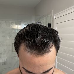 Anderson Center for Hair - Before procedure