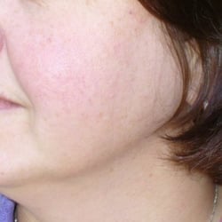 Transformations - Acne Treatment - successful acne treatment - www.TransformationsSkinCenter.com Charlotte NC