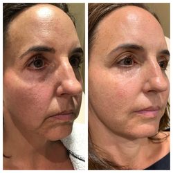 Mandisa Wellness & Aesthetics - Before and after tox and filler