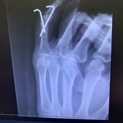 Evergreen Spine and Pain Centers - After surgery