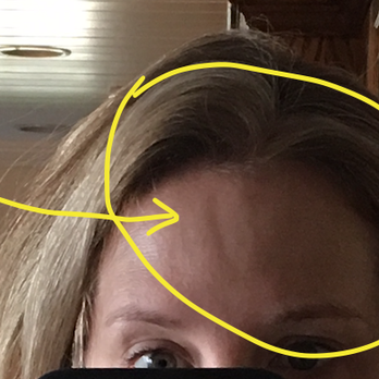 beyond AESTHETICS - Indent in forehead after botox - Medical Spas Near Me - Camarillo, California beyond AESTHETICS - Indent in forehead after botox - Medical Spas Near Me - Camarillo, California