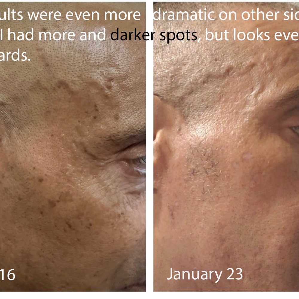 Before & After (Right Side) (My left--not shown--had 2x as many + much darker spots, so transformation there is even more dramatic) Before & After (Right Side) (My left--not shown--had 2x as many + much darker spots, so transformation there is even more dramatic)